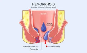 Haemorrhoids